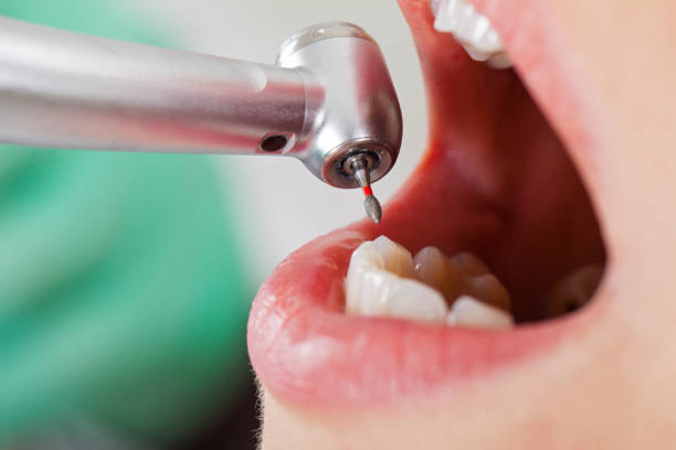 Best Emergency Dentist for Knocked-Out Tooth in Aliso Viejo, CA